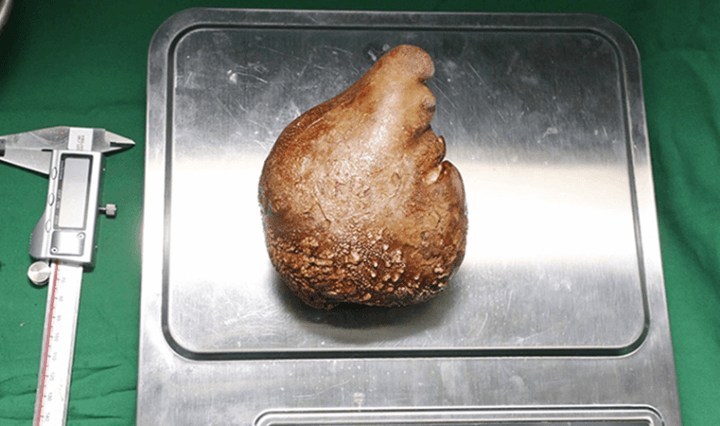Biggest kidney stone ever removed from a patient breaks Guinness World Record