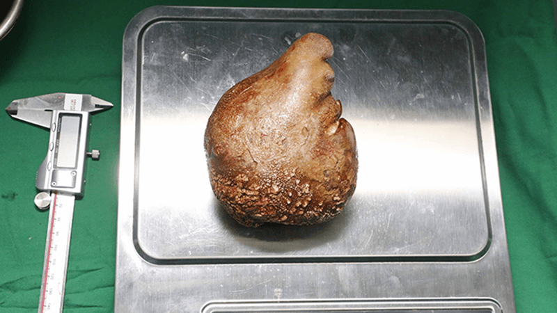 Biggest kidney stone ever removed from a patient breaks Guinness World Record