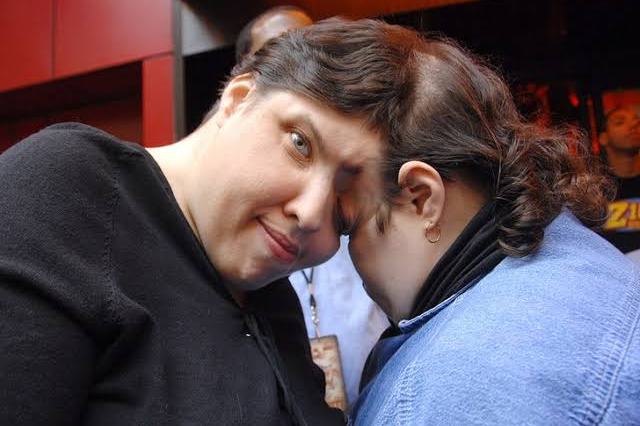 Oldest conjoined twins in the world dies at 62