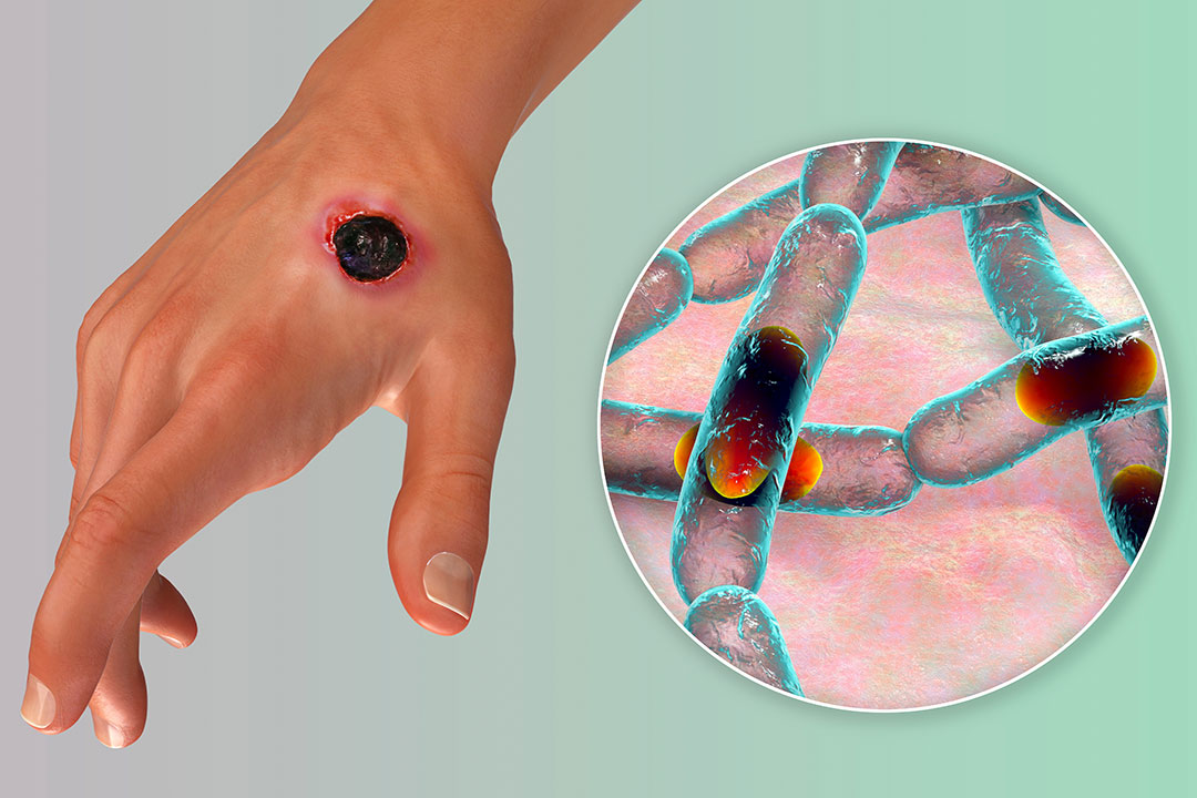 FG confirms first 'Anthrax' case in Niger state