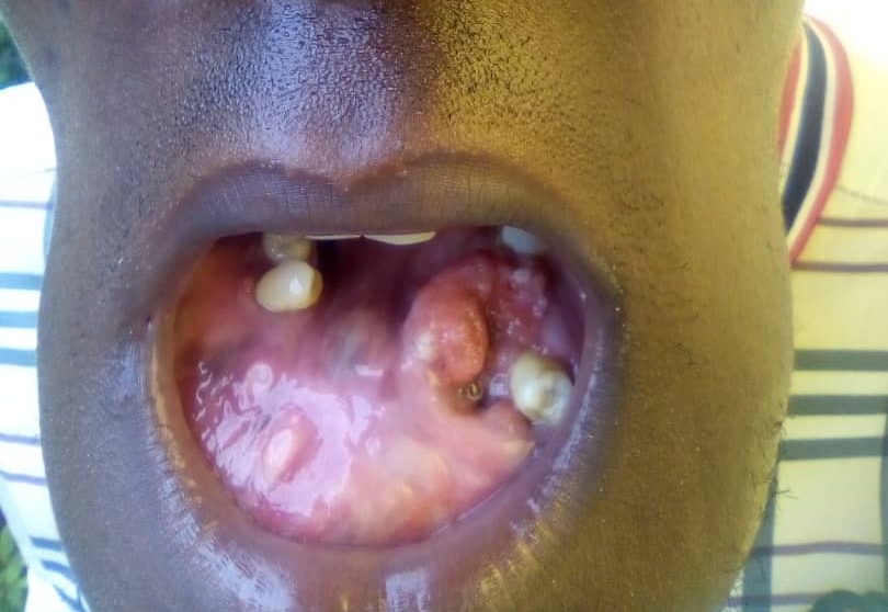 Family of 21 year old orphan appeals for assistance in treating diagnosed mouth tumour