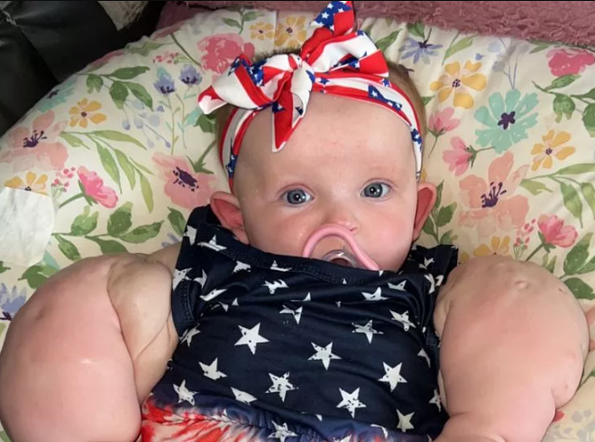 "Baby Hulk": Infant born with enormous chest and arms gains worldwide attention
