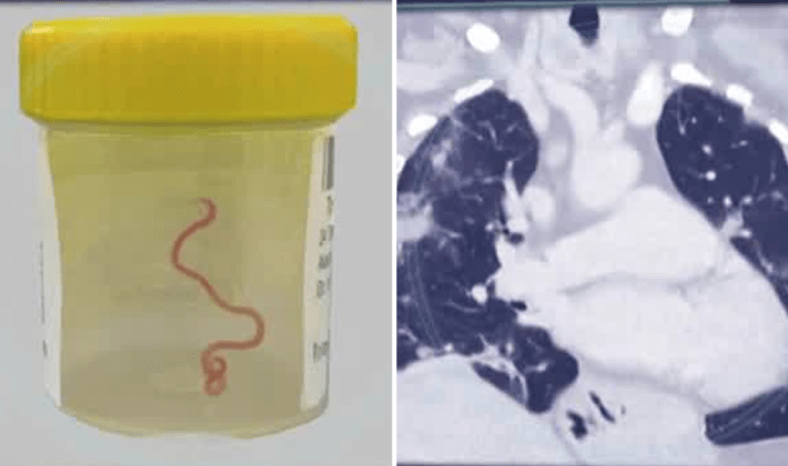 Live worm found in Australian woman's brain