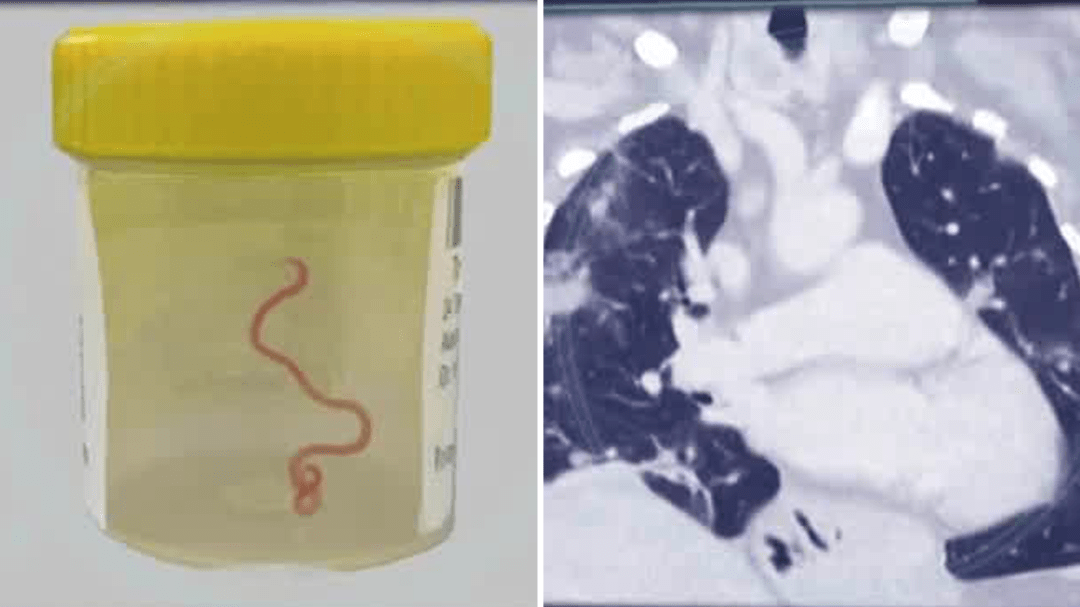 Live worm found in Australian woman's brain